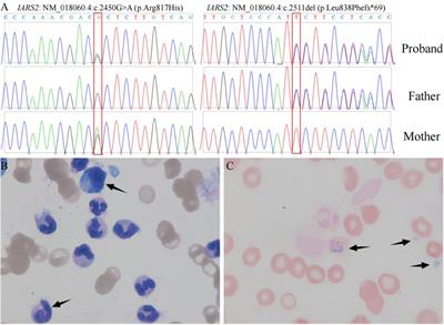 IARS2-related disease manifesting as sideroblastic anemia and hypoparathyroidism: A case report